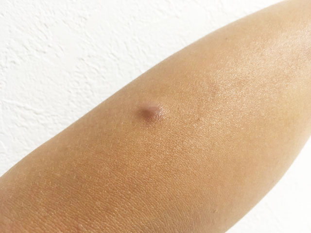 腕にできた粉瘤